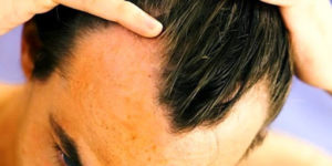 Tribulus Terrestris causa queda de cabelo