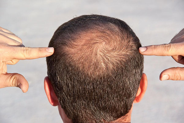 Tribulus Terrestris causa queda de cabelo?